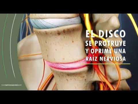 Hernia de disco lumbar, Dr. Dorantes