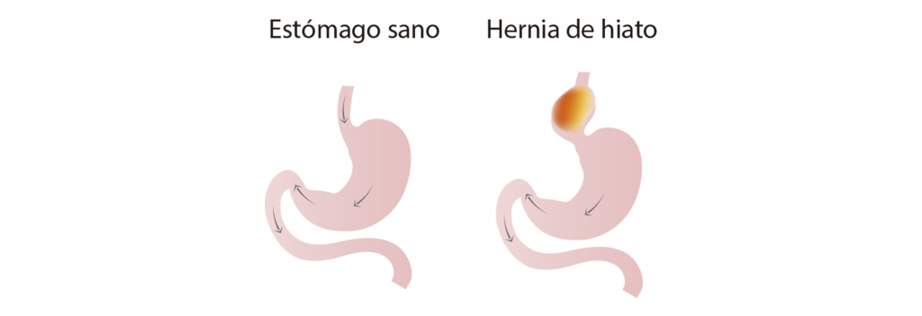 Hernia Hiatal ¿qué Es Causas Síntomas Y Tratamiento Centro Medici